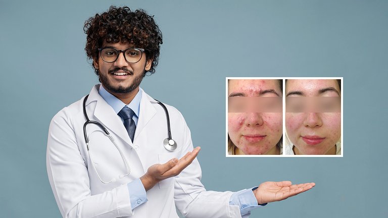 Acne Scar Treatment