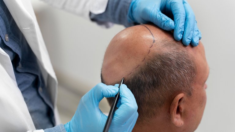 Hair Transplant 1