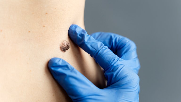 Mole removal