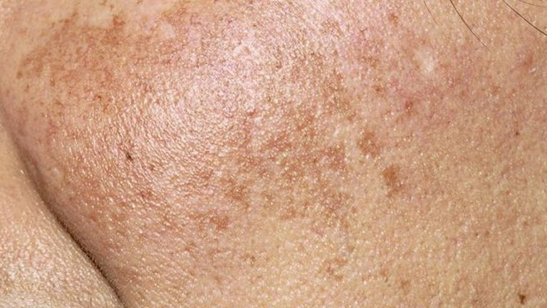 Pigmentation