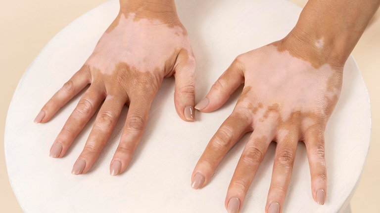 Vitiligo Surgery